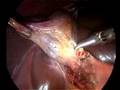 Colecistectomia (Cholecystectomy ) laparoscopica con dissettore ad ultrasuoni.