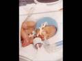 Prematurity...A BIG problem!!!