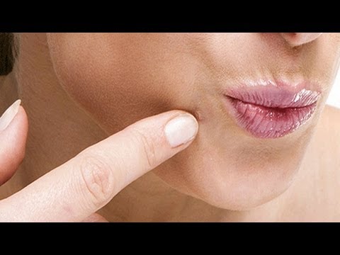 how to cure warts on face