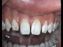 LaserBonding - Dr. MSc Peter Kleemann