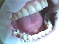 Zirconia Dental Implant Surgery (lower molar)