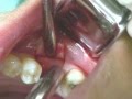 CeraRoot Zirconia Dental Implant Surgery (lower molar)