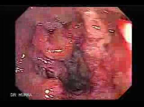 Colonoscopy of a rectal Cancer with ...