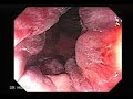 Colonoscopy of a rectal Cancer with Hemorrhoids