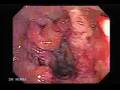 Colonoscopy of a rectal Cancer with Hemorrhoids