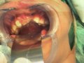 Case Presentation 4 Cleft Lip & Palate, stage 3,  Clinical Pediatric Dentistry