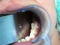 Case Presentation 4 Cleft Lip & Palate, stage 3,  Clinical Pediatric Dentistry