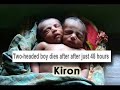 2-Headed Baby & Abortion 2-Headed Baby & Abortion