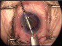 Descemet Stripping Automated Endothelial Keratoplasty 4