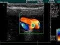 Vascular Coiling In Doppler Examination Vascular Coiling In Doppler Examination