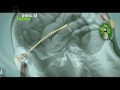 Cortivis - Cortical Visual Neuroprosthesis for the blind
