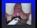 Multiple Missing Anterior Teeth- Esthetic management