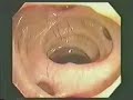 Irritable Bowel Syndrome: Tips on Controlling Your Symptoms