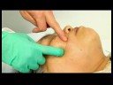 Acupuncture Facial Rejuvenation : Acupuncture Facial Rejuvenation: Cheek Muscle