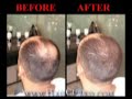 Rogaine Solution for thinning hair, How to use - hair second product - More Effective Rogaine Solution for thinning hair, How to use - hair second product - More Effective