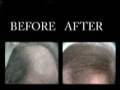 Rogaine Solution for thinning hair, How to use - hair second product - More Effective