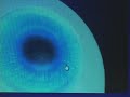Precision Laser Eye Precision Laser Eye