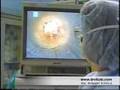 NJ plastic surgery breast augmentation surgery video Dr Vitolo