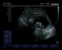 Our Pregnancy (12 weeks 5 days) - Baby's heartbeat