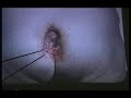 Pressure sores ii