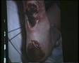 Pressure sores ii