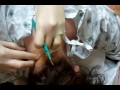 plugged sebaceous (sweat) gland:lancet procedure
