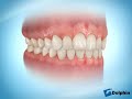 Invisible Aligners