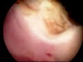 Hysteroscopic myomectomy