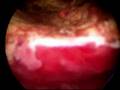 Hysteroscopic myomectomy
