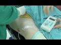 Femoral Nerve Block & Sciatic Nerve Block for TKA Femoral Nerve Block & Sciatic Nerve Block for TKA