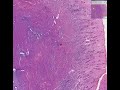 Histopathology Uterus--Adenomyosis Histopathology Uterus--Adenomyosis