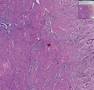 Histopathology Uterus--Adenomyosis