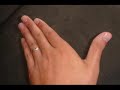 EM Procedures - Central Line part 5