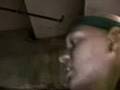 NBA Star Alopecia Areata