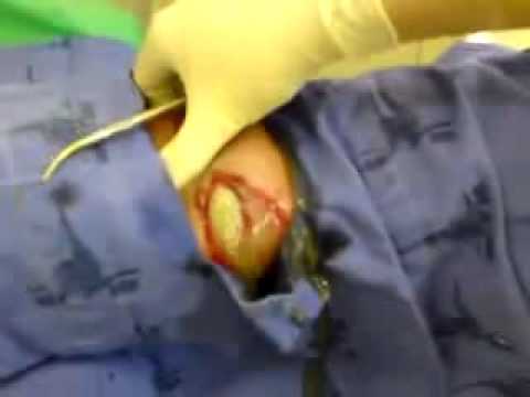 Abscess drainage.swf.avi
