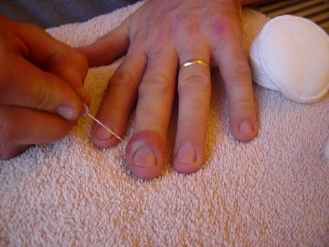 how to drain infected finger
