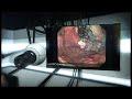 Gastric Cancer