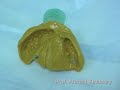 Case Presentation 3 Cleft Lip & Palate, Clinical Pediatric Dentistry