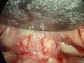 Endoscopic Meningioma Surgery - Skull Base Institute