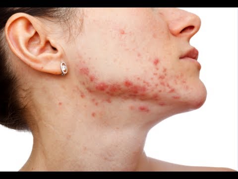 how to remove acne scars fast