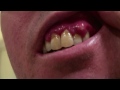 Abscess in mouth