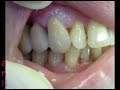 denti in ceramica impianti ankilos noritake creation ivoclar denti in ceramica impianti ankilos noritake creation ivoclar
