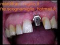 denti in ceramica impianti ankilos noritake creation ivoclar