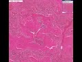 Histopathology Spleen --Amyloidosis