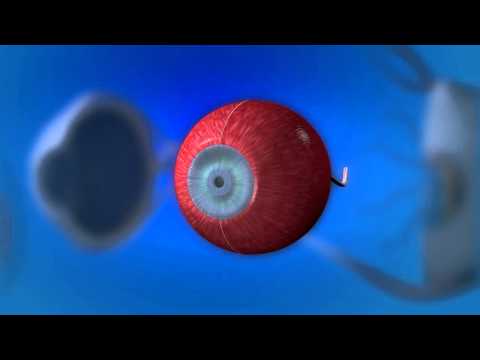 Видео Сосудистая оболочка глаза