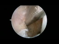 Arthroscopic Knee Surgery - USC Dr. Vangsness