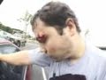 Skateboard Accidents