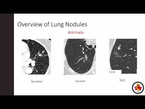 Lung Nodules - Where and When to Refer