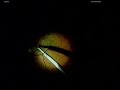 RETINAL SURGERY