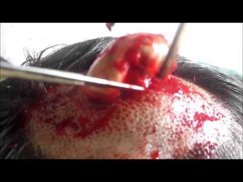 how to drain cyst on scalp